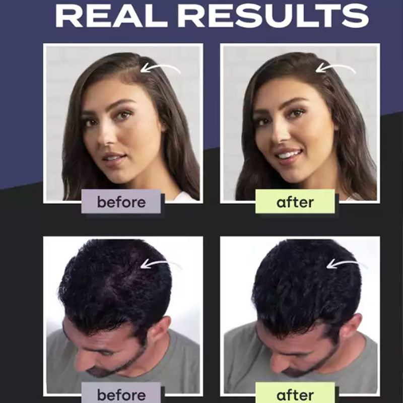 💖Limited Sale 50% OFF💖Hair Building Fibers Set for Thinning Hair & Bald Spots